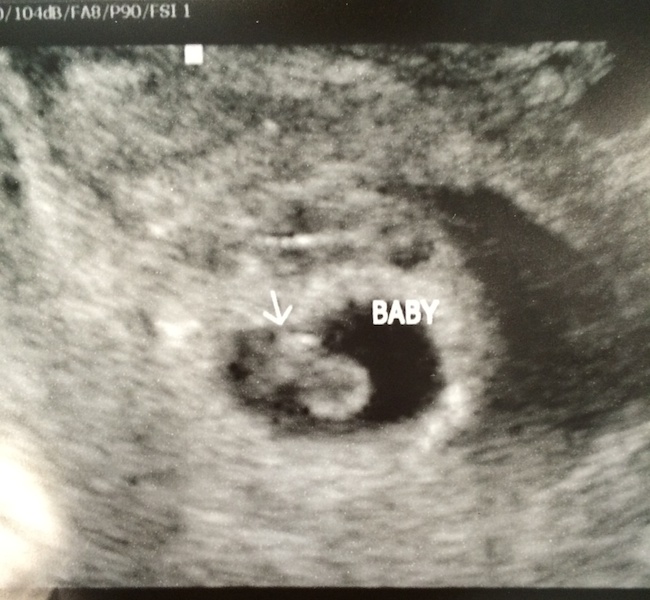 6 weeks 5 days ultrasound.