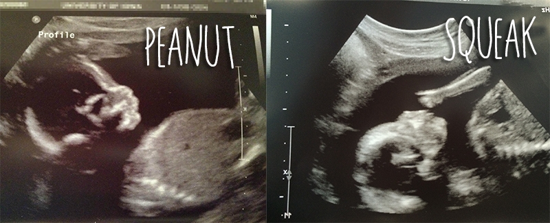 20-week-ultrasounds-both-babies