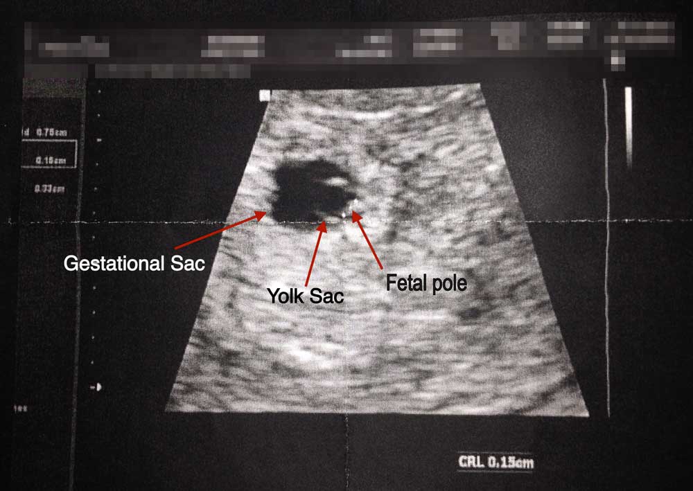 Ultrasound 5 weeks 4 days